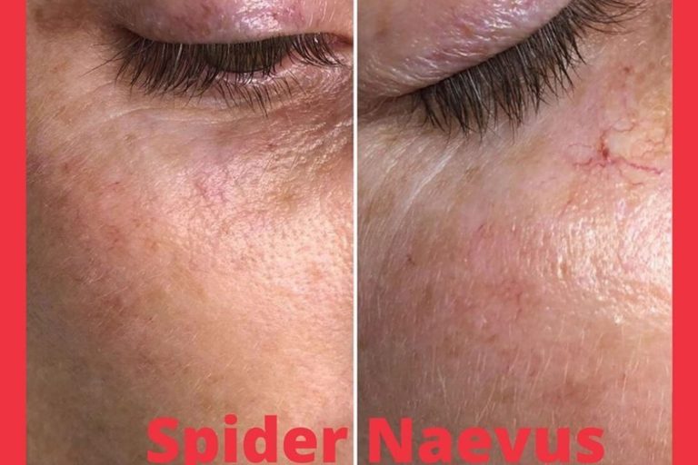 Lamprobe Skin irregularities - noninvasive method | Violet Skin Boutique